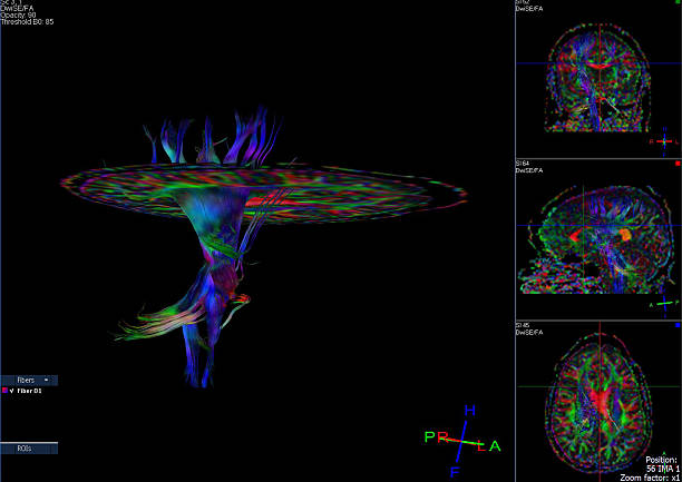 tractography (dti- tensor de difusão de imagens de mri) do cérebro - neuroscience mri scan brain brain surgery - fotografias e filmes do acervo