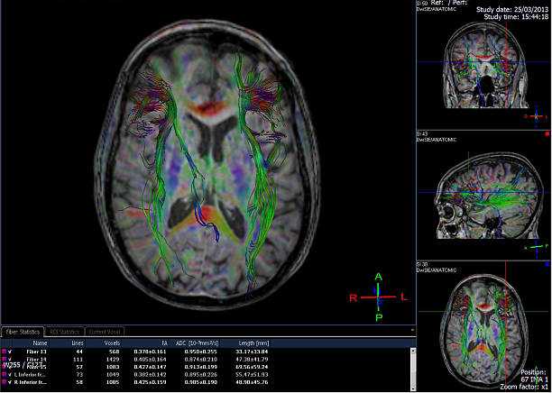 imágenes generadas por ordenador de cerebro tractografía - mri scan human nervous system brain medical scan fotografías e imágenes de stock