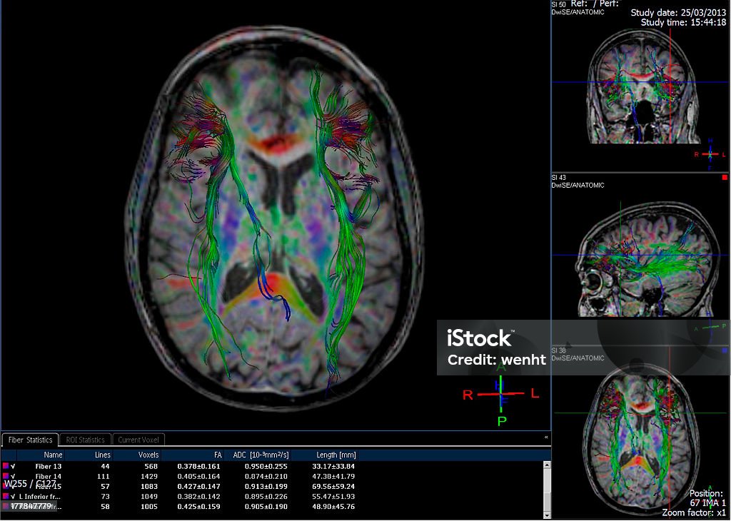Computador gerado imagem de cérebro tractography - Royalty-free Máquina de Ressonância Magnética Foto de stock