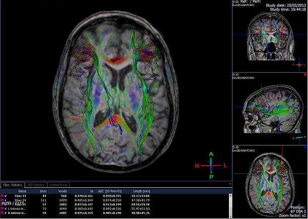 imagem gerada por computador do cérebro tractography - neuroscience mri scan brain brain surgery - fotografias e filmes do acervo