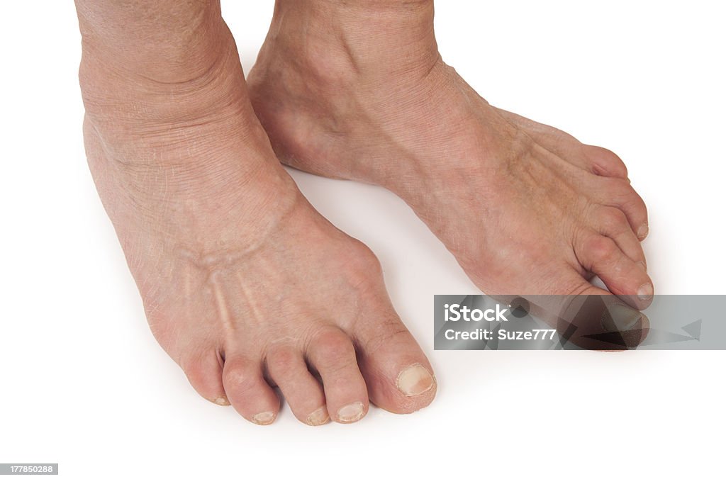 Mulher velha Foots Deformado de Rheumatoid artrite - Foto de stock de Artrite reumatoide royalty-free
