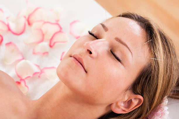 mulher sob tratamento de acupunctura - massaging alternative medicine headache women imagens e fotografias de stock