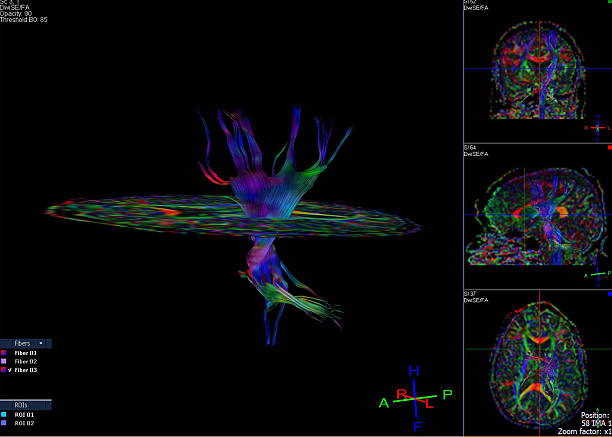 tractografía (dti- imágenes con tensor de difusión de mri) de cerebro - mri scan human nervous system brain medical scan fotografías e imágenes de stock