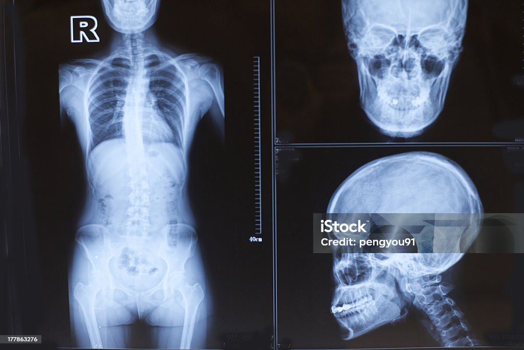 Menschlichen Körper X-ray Fotos - Lizenzfrei Anatomie Stock-Foto