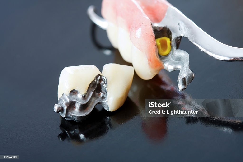 prosthesis dentário - Foto de stock de Prótese esquelética royalty-free