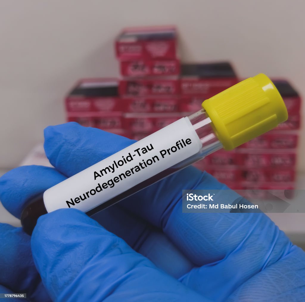 Blood Sample For Atn Profile Test To Diagnosis Of Alzheimers Disease Blood Sample For Atn Profile Test To Diagnosis Of Alzheimers Disease