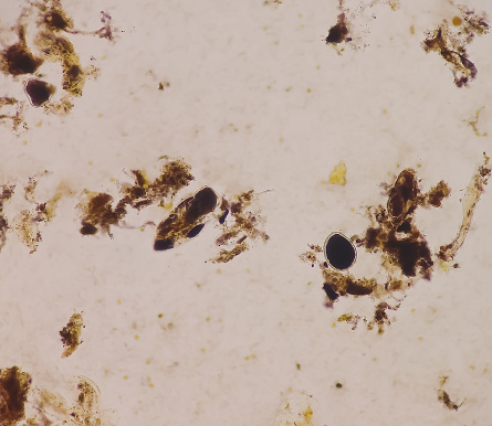 Parasitic Ova And Cysts And Trophozoite Form Muscle Fiber In Stool