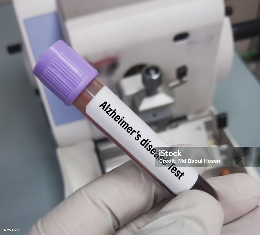 Blood Sample For Atn Profile Test To Diagnosis Of Alzheimers Disease Blood Sample For Atn Profile Test To Diagnosis Of Alzheimers Disease
