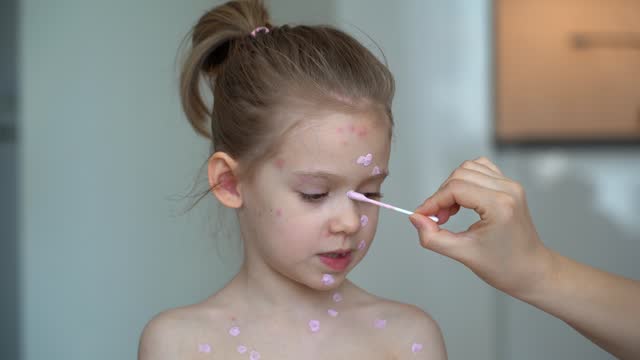 Mothers hands applies ointment on face of sick girl with chickenpox