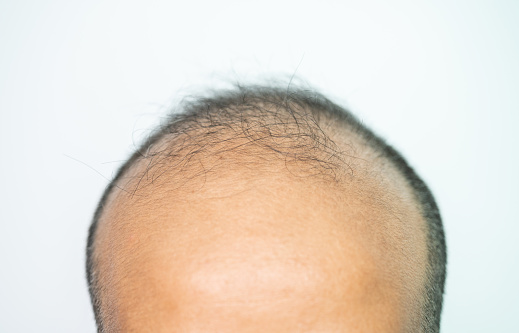 It usually follows a pattern of receding hairline and hair thinning on the crown.