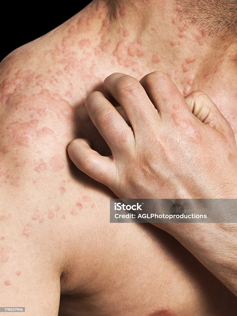 Man kratzen Allergische Haut - Lizenzfrei Ekzem Stock-Foto