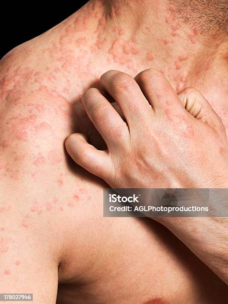 Man Kratzen Allergische Haut Stockfoto und mehr Bilder von Ekzem - Ekzem, Dermatitis, Männer