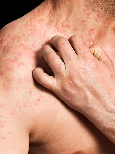 Man Scratching Allergic Skin stock photo