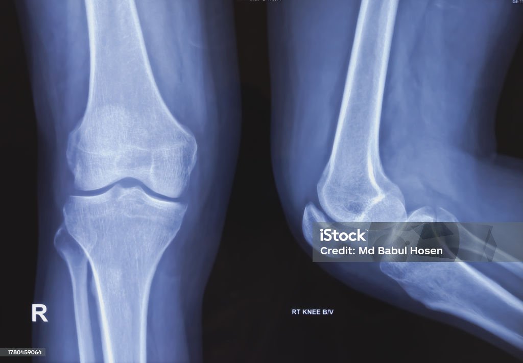 Knee Rontgen Normal Plain X Ray Of Knee Joint Both View Normal Finding Detected Stock Photo ...