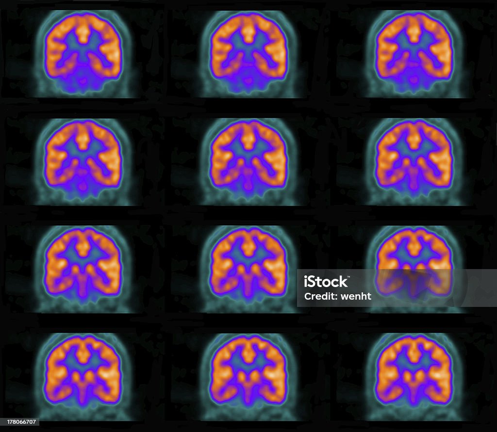 PET (positron Emissionen tomography) scan des Gehirns - Lizenzfrei PET-Scan Stock-Foto