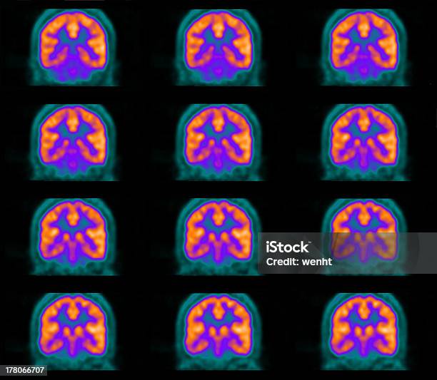 Pet Scan Des Gehirns Stockfoto und mehr Bilder von PET-Scan