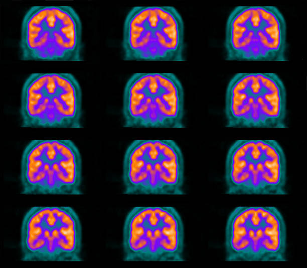 emissione di positroni (positron emission tomography, pet) del cervello - pet foto e immagini stock