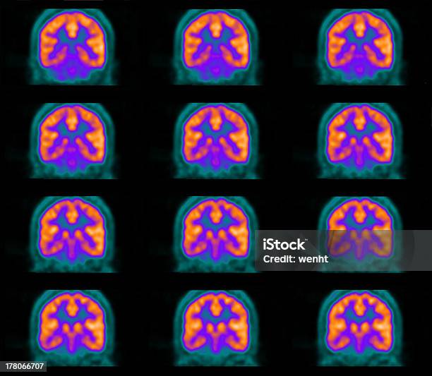Pet スキャンの脳 - PET検査のストックフォトや画像を多数ご用意 - PET検査, 脳, 悪性腫瘍