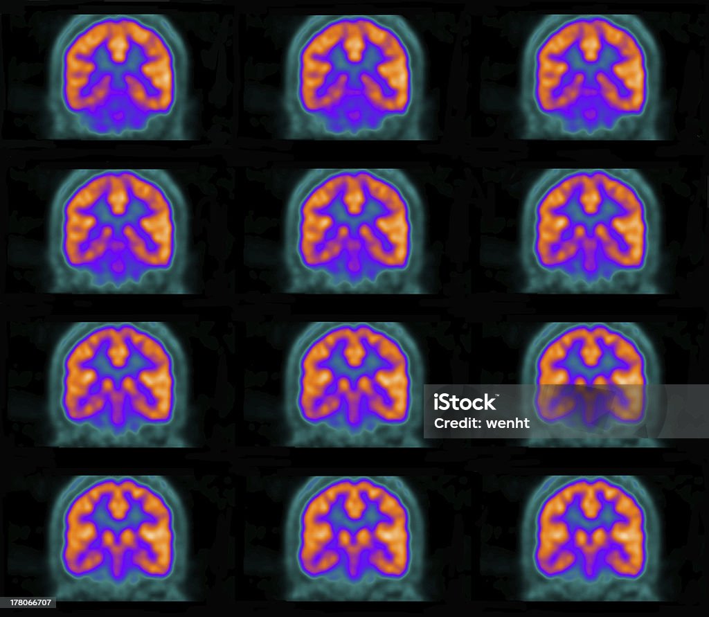 (positron emission tomography, PET) 스캔은 뇌 - 로열티 프리 PET 스캔 스톡 사진