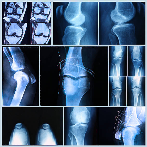 kolano badanie lekarskie - x ray human knee orthopedic equipment human bone zdjęcia i obrazy z banku zdjęć