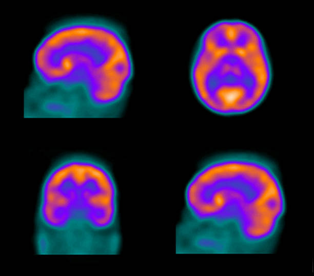 un fotone emissione spect (tomografia computerizzata) del cervello - mri scan human nervous system brain medical scan foto e immagini stock