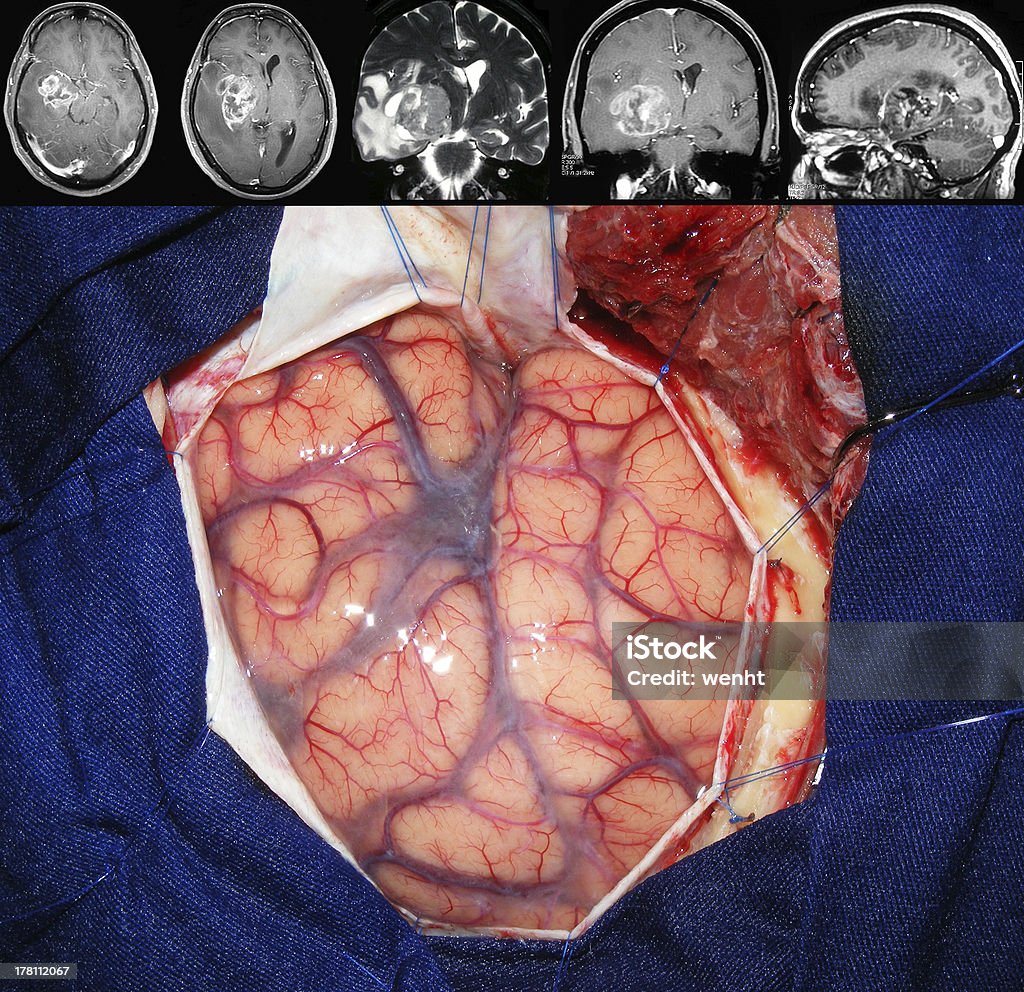 tumor cerebral la cirugía - Foto de stock de Cáncer de cerebro libre de derechos