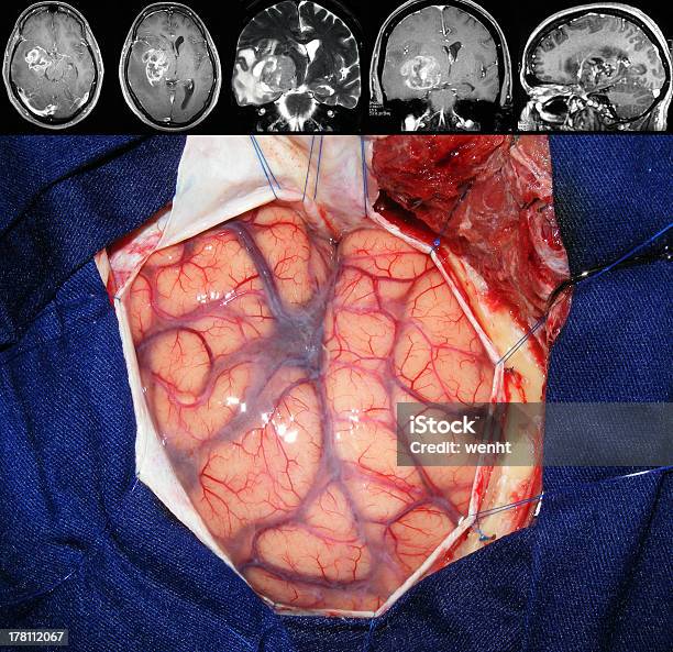 Brain Tumor Surgery Stock Photo - Download Image Now - Brain Tumour, Oncology, Radiation - iStock Brain Tumor Surgery Stock Photo - Download Image Now - Brain Tumour, Oncology, Radiation - iStock