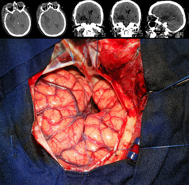 guza mózgu, zabieg chirurgiczny - human nervous system cat scan brain doctor zdjęcia i obrazy z banku zdjęć