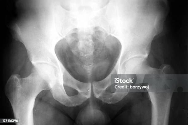 Anca Raios X - Fotografias de stock e mais imagens de Osso do quadril - Osso do quadril, Anatomia, Branco