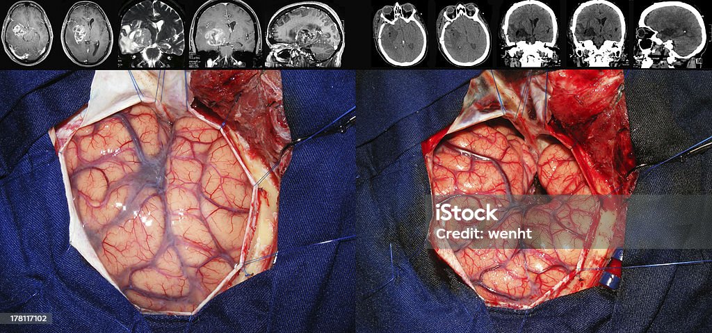 Brain Tumor Surgery Stock Photo - Download Image Now - Brain, MRI Scan,  Gyrus - iStock
