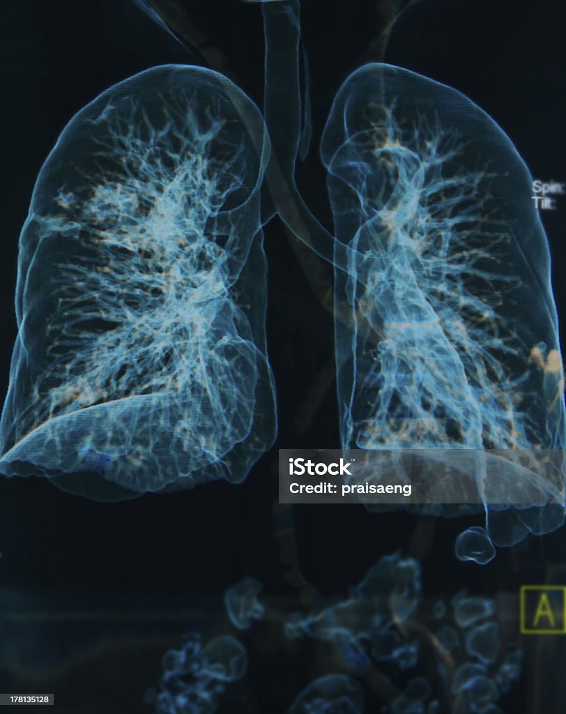 chest X-rays lungs 3d image Chronic Obstructive Pulmonary Disease Stock Photo