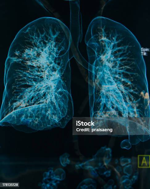 Chest Xrays Lungs 3d Image Stock Photo - Download Image Now - Chronic Obstructive Pulmonary Disease, Back Lit, Bronchitis