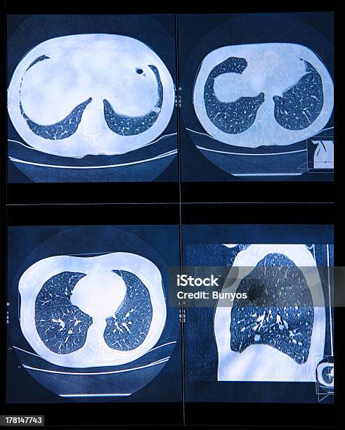 Mri Scan Menschliche Lunge Stockfoto und mehr Bilder von Magnetresonanztomographie - Magnetresonanztomographie, Computertomogramm, Brustkorb - Menschlicher Knochen