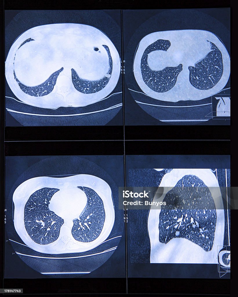 MRI skanowania ludzkiego płuc - Zbiór zdjęć royalty-free (Obrazowanie magnetyczno-rezonansowe)