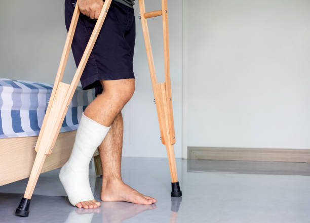Close-up patient with broken leg in cast and bandage, man with leg splin is walking support with crutches at home stock photo