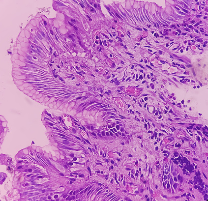 Tissue from antrum of stomach (endoscopic biopsy): Chronic nonspecific gastritis. Show gastric mucosa, chronic inflammatory cells infiltration in the lamina propria.
