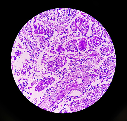 Human meningioma. Meningioma cells are relatively uniform, with a tendency to encircle one another, forming whorls and psammoma bodies, concentric laminated eosinophilic bodies that tend to calcify