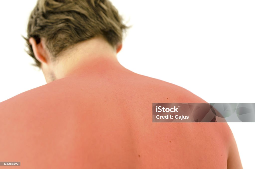 Sunburn Sunburned male back. Isolated over white background. Sunburned Stock Photo