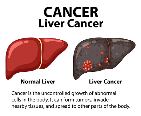 Infographic illustrating the differences between healthy and cancerous liver cells