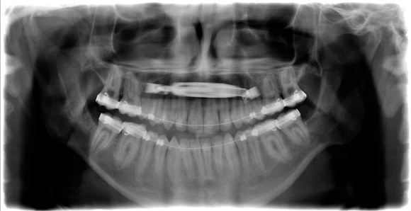 Dental X-Ray of mouth after orthodontic treatment - Orthodontic treatment of malocclusions as a result of disproportionate jaw relationships