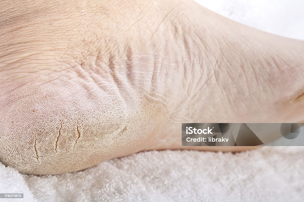 Feet that need a pedicure close up of Feet that need a pedicure Cracked Stock Photo