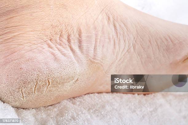 Feet That Need A Pedicure Stock Photo - Download Image Now - Cracked, Human Foot, Bad Condition