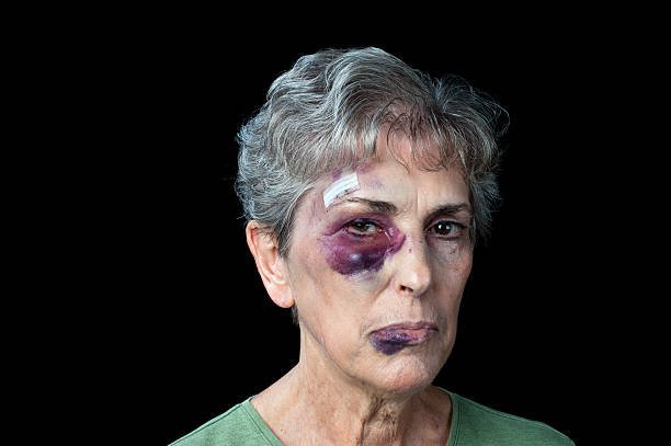 Beaten old woman "An elderly grandmother badly beaten with stitches, a black eye and a fat lip." bruise stock pictures, royalty-free photos & images