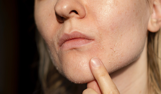 The woman skin flakes off at the mouth. Dry skin. Face skin irritation after peeling, after cold windy weather. Dark background, view by profile. She is showing the problem with the finger.