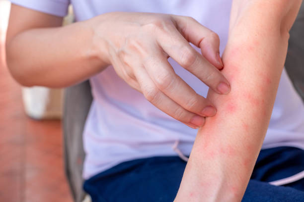 Close up of woman arm scratch the itch by hand at home, itching due to rash, fungus, allergy, dermatological disease, dry skin. Healthcare and medical concept. stock photo