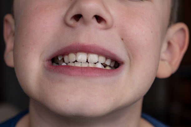 istock Child's crooked teeth. Young man showing crooked growing teeth. 1783958870