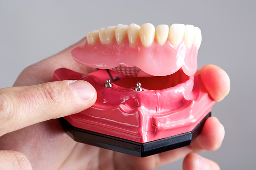 doctor holding a set of teeth with an implant to attach dental prothesis.
