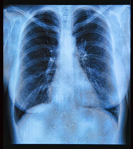 radiografia del torace - human lung asthmatic x ray human internal organ foto e immagini stock