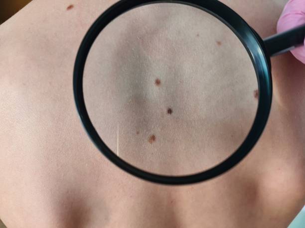 istock Dermatologist with magnifying glass examines patient in clinic 1784860306