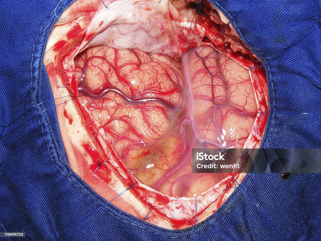 Arteriovenous malformation (AVM) in das Gehirn - Lizenzfrei Blauer Hintergrund Stock-Foto